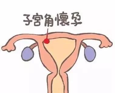 怀孕6周3天，孕囊外缘距右侧宫角浆膜层约0.57cm，以后孕囊位置还能变吗？