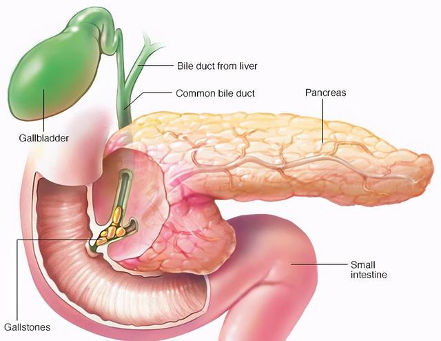 与胆结石有关的胰腺炎—胆源性胰腺炎