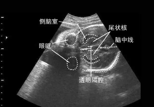 胎儿透明隔腔及左侧侧脑较宽，有问题吗？