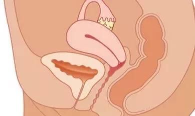 子宫内膜厚影响怀孕吗？