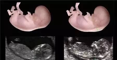二胎宝宝，十二周NT检查。查出胎儿颈部透明层增厚，胎儿颈部淋巴水囊瘤。怎么办？