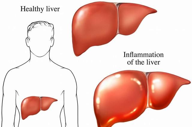 肝脏不好会有什么表现？如何有效的养护肝脏？