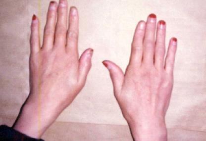 手指关节痛怎么治疗?筋针治疗