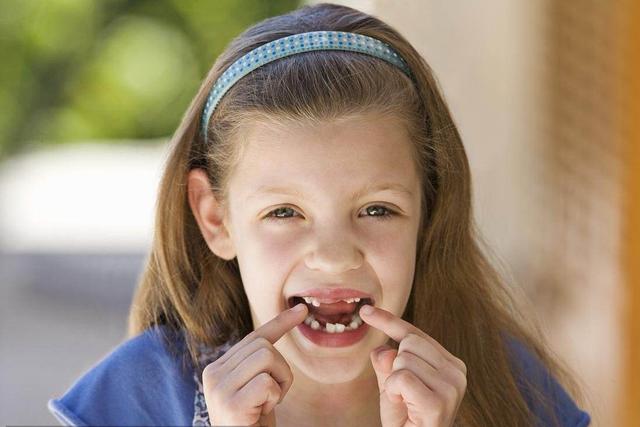 儿童乳牙早失致恒牙长歪，早戴间隙保持器就好了，换牙期家长必看