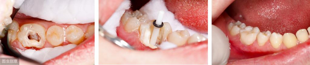 给牙齿打桩是什么意思？有什么作用？牙齿修复之前你要知道这些