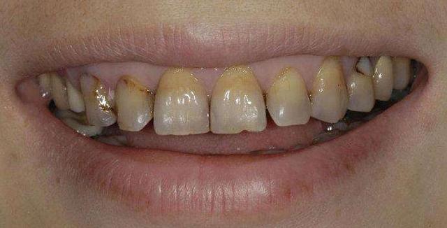 四环素牙又黄又难看，十分影响雅观，牙科医生教你三招有用应对