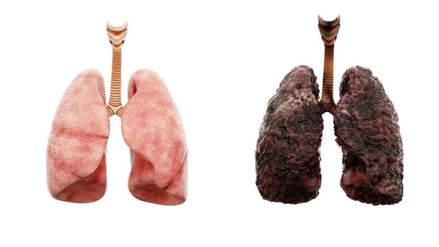 肺欠好，常与3种